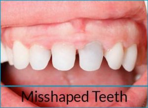 cosmetic-dentistry-problems-misshaped-teeth