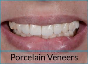 cosmetic-dentistry-solutions-porcelain-veneers
