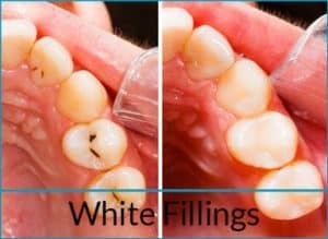 cosmetic-dentistry-solutions-white-fillings