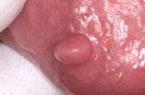 fibroma before case study