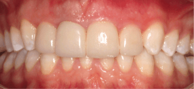 invisalign-veneers-after