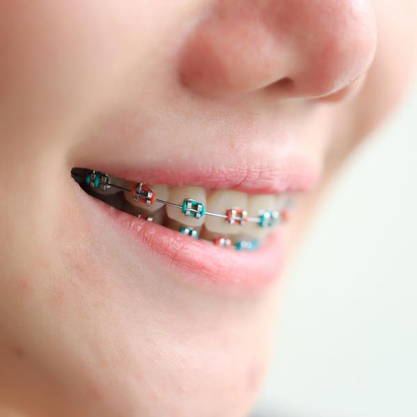 Smile with Coloured Braces