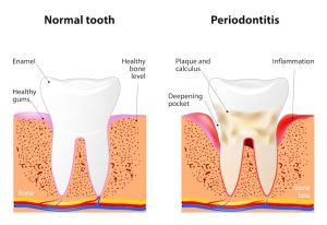 periodontal disease