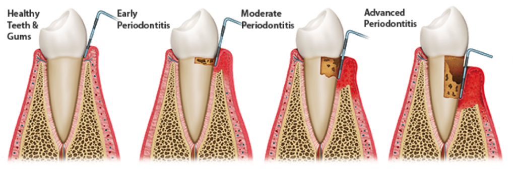 periodontitis-stages