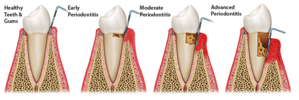 periodontitis stages