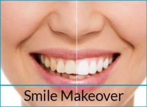 cosmetic-dentistry-solutions-smile-makeover