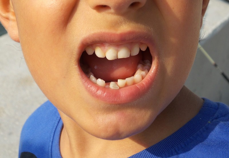 dental trauma in children