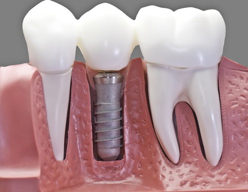 restoration procedure for dental implants