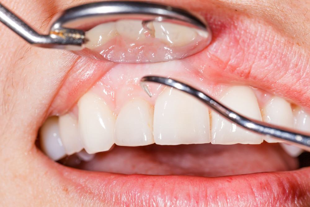 swollen gums causes symptoms treatment
